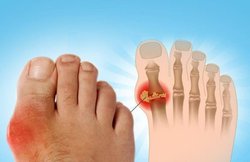 Uric Acid के कारण ज्यादा होता है किडनी और हार्ट डिजीज का खतरा, इन नैचुरल उपायों से पाएं निजात