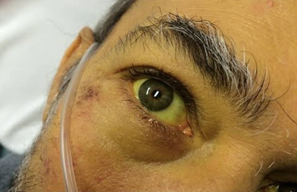 jaundice, jaundice symptoms, jaundice home remedies, पीलिया jaundice, jaundice symptoms, jaundice home remedies, पीलिया