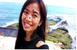 moles, how to remove moles, lifestyle