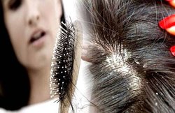 Hair Care Tips: सर्दियों में भूलकर भी न करें यह 4 गलतियां, बालों में बढ़ सकती है डैंड्रफ की समस्या