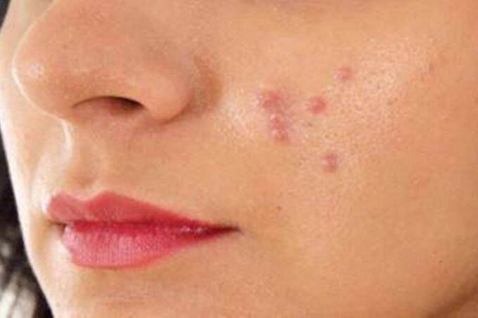 Skin Care, skin glow, pimples, dark spots, dark circle