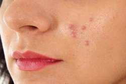 Skincare: इन 5 आम गलतियों को दोहराने से बचें, कम होगा पिंपल्स का&nbsp;खतरा