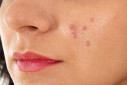 Skin Care, skin glow, pimples, dark spots, dark circle