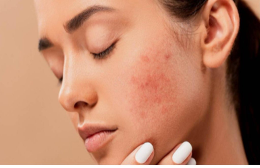 skin care, skin routine, pimple problem