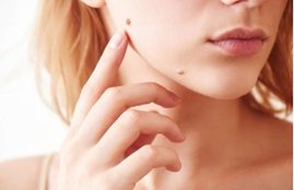 warts, lifestyle, lifestyle news