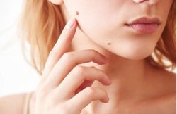 अधिक मस्सों की समस्या ने कर दिया है परेशान? बिना दर्द के ये घरेलू उपाय दिला सकते हैं निजात