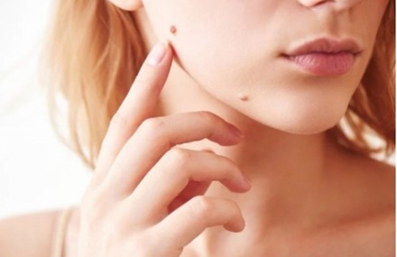 warts-removal-home-remedies-natural-treatment-hpv-skin-care-tips-hindi
