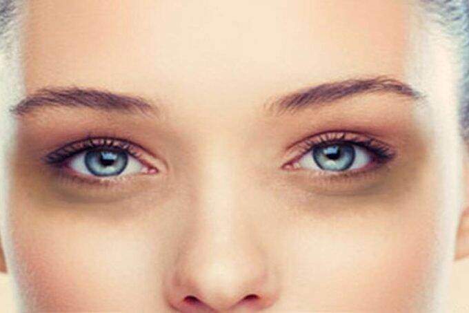 Dark circle, Beauty tips, dark circle home remedies
