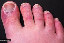 blood sugar, hyperglycemia, high blood sugar ke lakshan