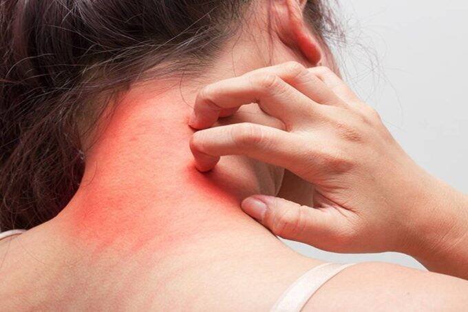 skincare tips, skin tips, beauty tips, skin infection, rashes