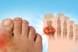 Uric Acid, high uric acid, high uric acid treatment