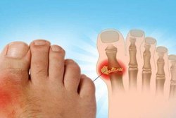 कब बढ़ सकता है Uric Acid का लेवल, एक्सपर्ट्स से जानें क्या हो सकता है नुकसान और कैसे करें&nbsp;बचाव?