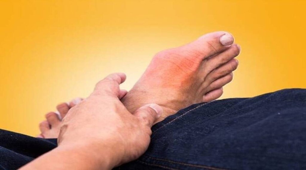 uric acid, uric acid diet, high uric acid remedy