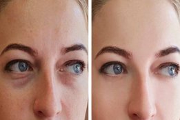 puffy eyes, lifestyle, lifestyle news