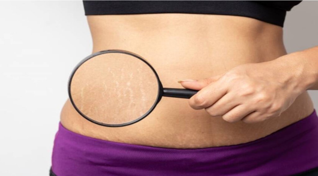 Lifestyle News, Pregnancy, Stretch Marks