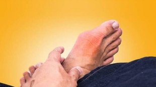 Uric Acid