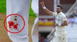 ind-vs-eng-james-anderson-continues-bowling-with-blooded-knee-and-pant-gets-red-photos-viral-from-oval-test