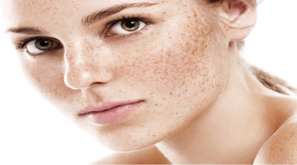 Lifestyle News, Skin Care, Freckles