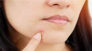 Lifestyle News, Home Remedies For Pimples, Skin Care