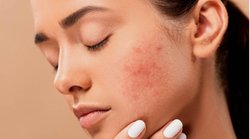 Skin Care: पिंपल्स का कारण बन सकते हैं ये खाद्य पदार्थ, आज ही बना लें दूरी