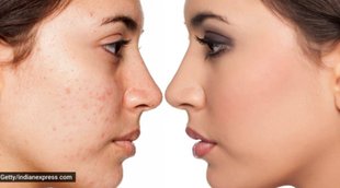 pimples, reason of pimples, how to treat pimples