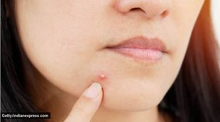 acne. acne reason, pimples