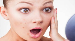 Lifestyle News, Pimples, Home Remedies For Pimples