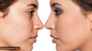 Skin Care, Pimples, Garlic In Pimples Removing