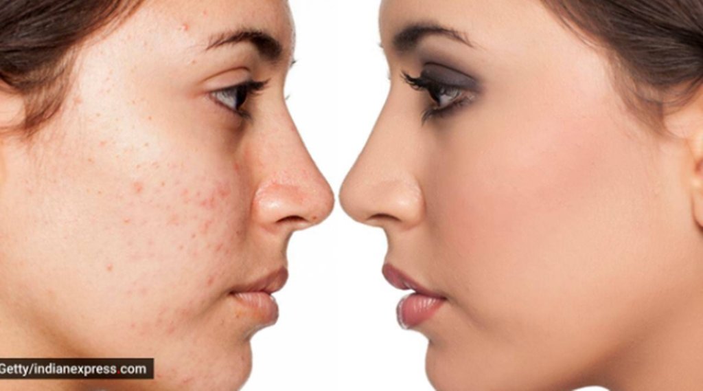 Skin Care, Pimples, Garlic In Pimples Removing