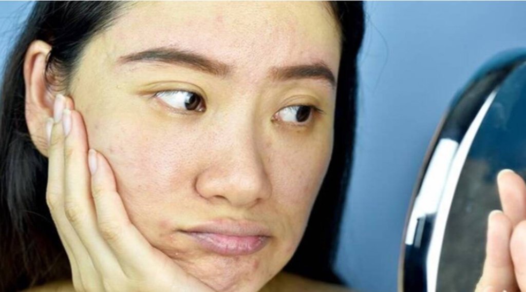 Skin Care, Lifestyle News, Blackheads
