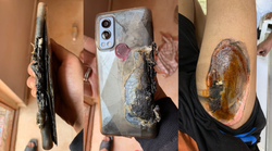 तीसरी बार फटा वनप्लस फोन! यूजर का दावा- OnePlus Nord 2 5G ब्लास्ट में जली जांघ; जानें- क्यों फट जाती है बैट्री?