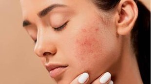 pimple problem, acne problem