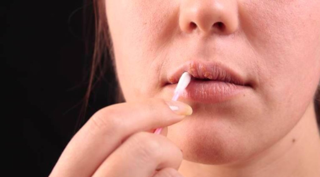 Cracked Lips, Lifestyle News, Lifestyle