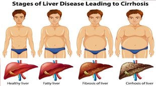 Fatty Liver Disease, What is fatty liver, causes of fatty liver, symptoms of fatty liver, types of fatty liver, how to avoid fatty liver, problem of fatty liver, yoga for fatty liver, fatty liver precautions, fatty liver causes, fatty liver treatment, fatty liver and diabetes, fatty liver home remedies, home remedies for fatty liver, fatty liver ka ilaj, fatty liver ki dawa, f