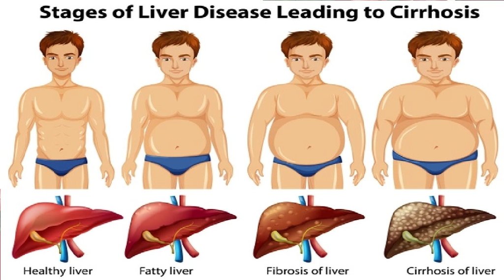 Fatty Liver Disease, What is fatty liver, causes of fatty liver, symptoms of fatty liver, types of fatty liver, how to avoid fatty liver, problem of fatty liver, yoga for fatty liver, fatty liver precautions, fatty liver causes, fatty liver treatment, fatty liver and diabetes, fatty liver home remedies, home remedies for fatty liver, fatty liver ka ilaj, fatty liver ki dawa, f