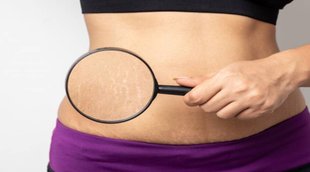 Stretch marks, lifestyle news