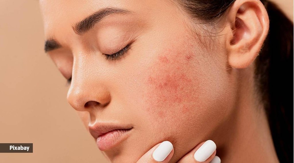 acne-pimples