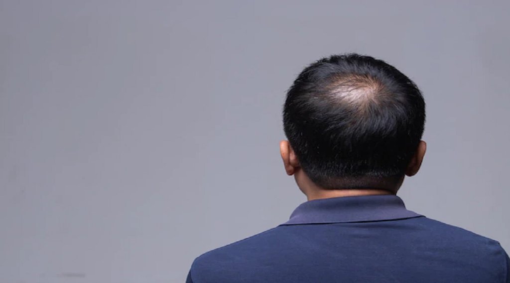आप भी बालों में गंजेपन से परेशान हैं तो सबसे पहले बालों के कम होने का कारण जानिए और हेयर एक्सपर्ट से उसका उपचार कराएं। फोटो-freepik