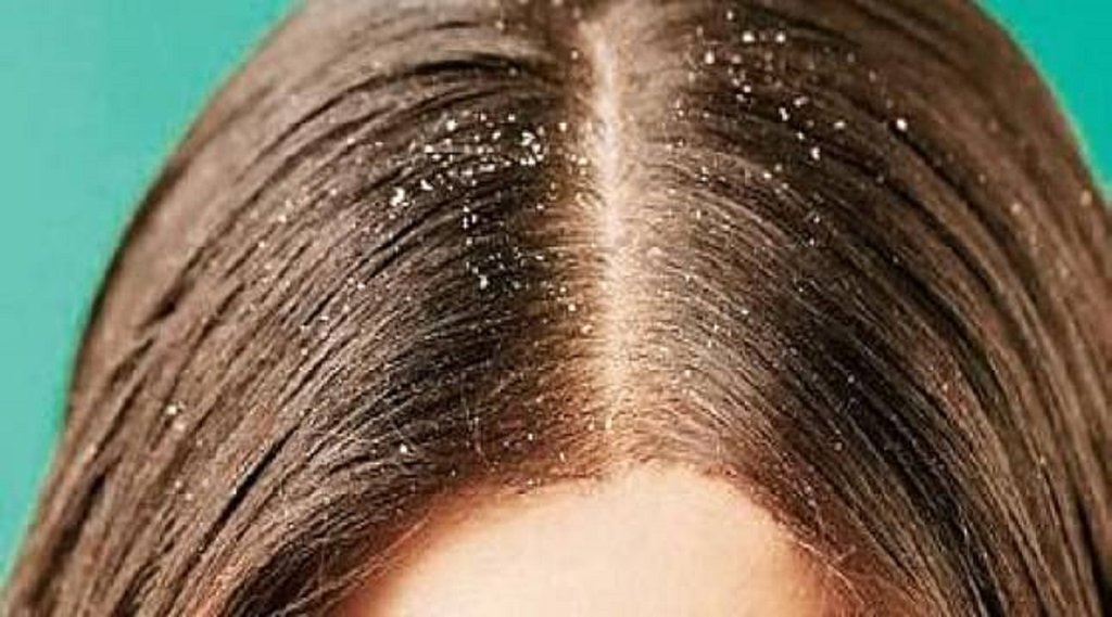dandruff | Dandruff cure | dandruff hair