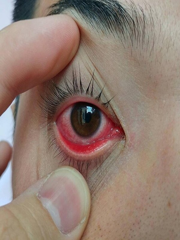 EYES INFECTION
