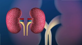 Kidney Stone treatment, kidney care, kidney health, kidney stone
