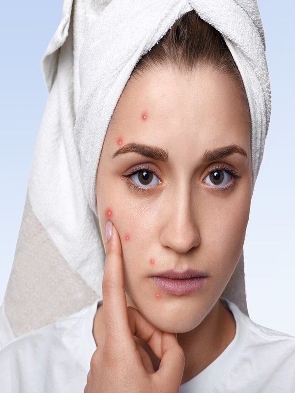 An isolated portrait of young woman having problem skin and pimp