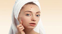 Skin Care Tips: इन 3 सप्लीमेंट्स की वजह से चेहरे पर हो सकते हैं मुहांसे, जानिये