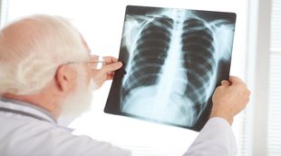 Pulmonary Tuberculosis, Tuberculosis,Tuberculosis in young age, Mycobacterium tuberculosis, Symptoms Of T.B,