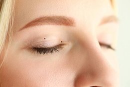 mole on eyelid, lucky mole