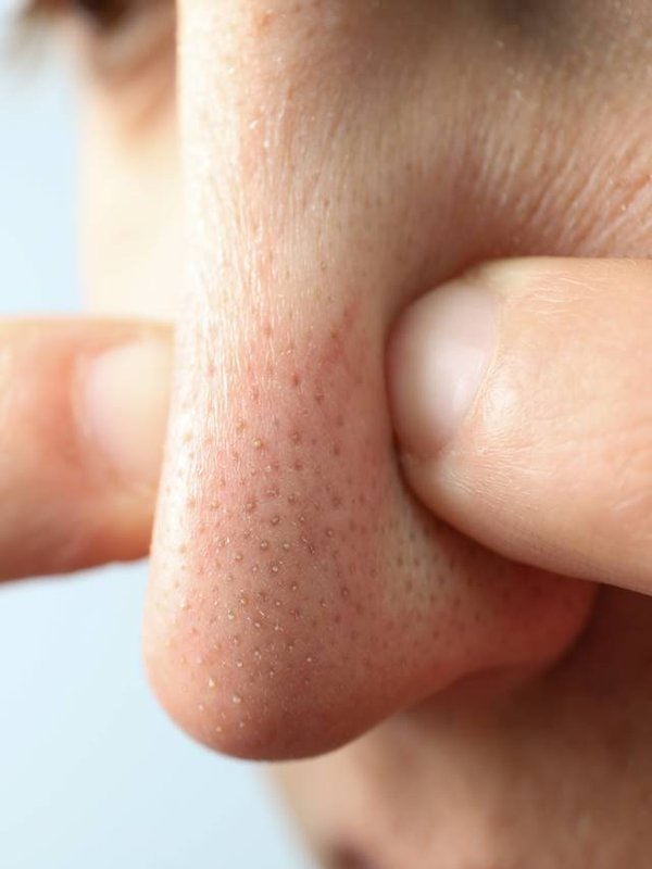 Concept of skin care with nose with dots