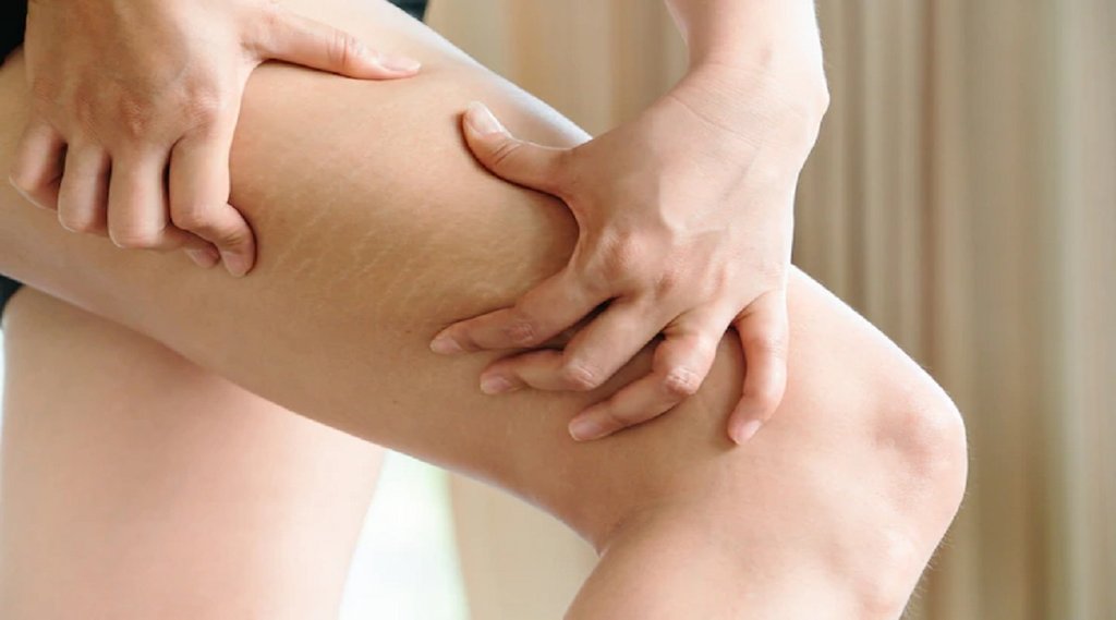 strech marks, strech marks home remedies, skin care tips
