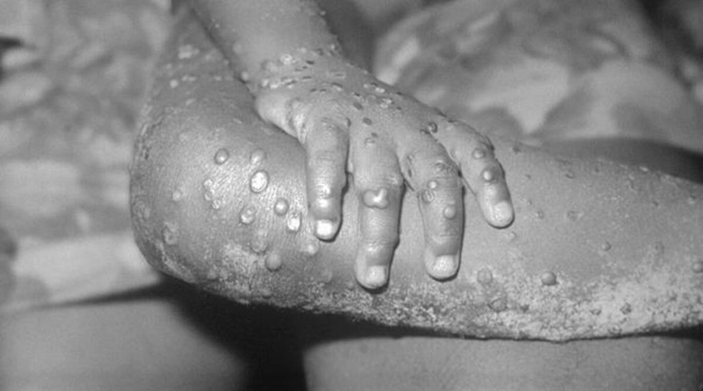Monkeypox