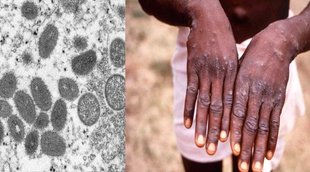 Monkeypox | UP News | Monkeypox in India