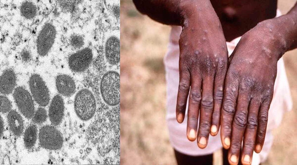 Monkeypox | UP News | Monkeypox in India Monkeypox | UP News | Monkeypox in India